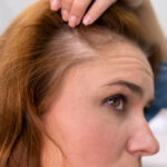 hair loss