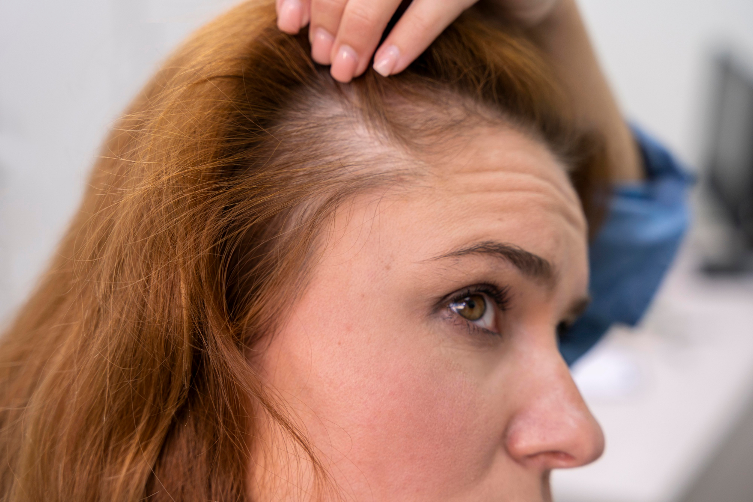 hair loss